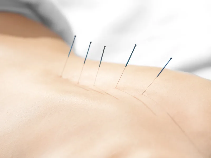 Acupuncture at Camel City Chiropractic in Hudsonville