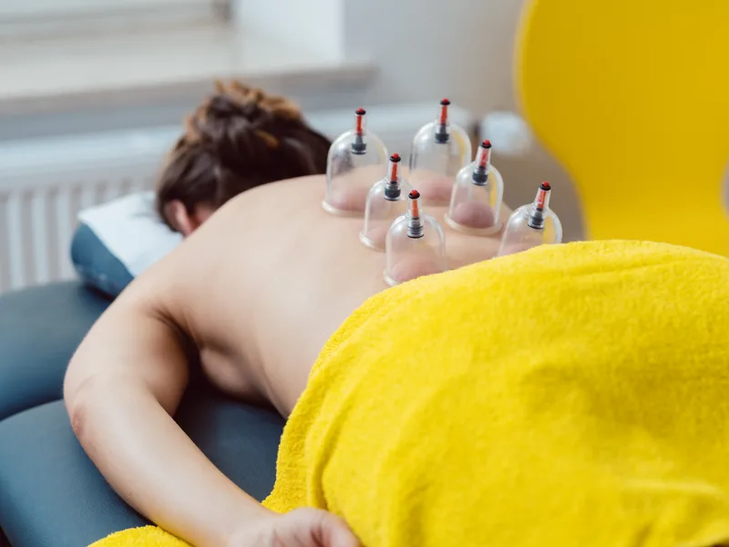 Cupping Therapy at Camel City Chiropractic in Hudsonville