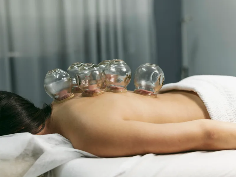 Cupping Therapy at Camel City Chiropractic in Hudsonville