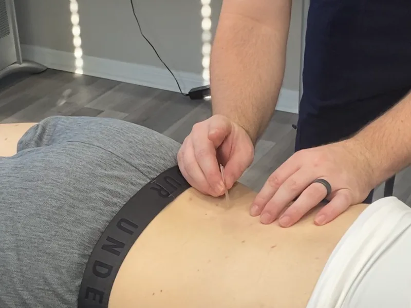 How Dry Needling works at Camel City Chiropractic