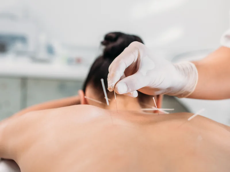 Dry Needling at Camel City Chiropractic in Hudsonville